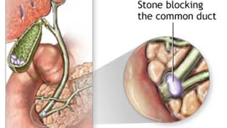 Choledocholithiasis amp Cholangitis [upl. by Idaline366]