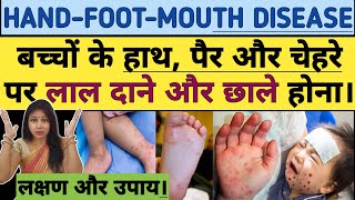 HAND FOOT MOUTH DISEASE  बच्चो के हाथ पैर और चेहरे पर लाल दाने या छाले। Symptoms and Treatment [upl. by Nairadas]