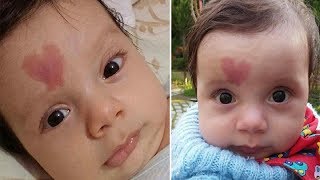 Baby with a Unique Birthmark Is Charming the Whole World [upl. by Sokil]