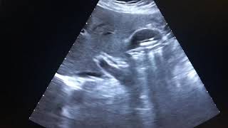 Ecografia abdominal Litiasis vesicular Abdominal ultrasound Vesicular [upl. by Bernice]