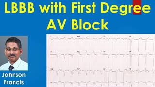 LBBB with First Degree AV Block [upl. by Haroun]