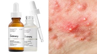 Top 7 Ordinary Skincare For Acne  How To Use [upl. by Yuma48]