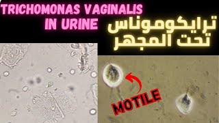 ترايكوموناس في عينة فحص البول Trichomonas vaginalis in urine sample [upl. by Takashi]