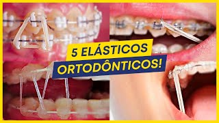 5 TIPOS de ELÁSTICOS MAIS COMUNS usados no APARELHO ORTODÔNTICO [upl. by Drarej]