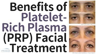 Benefits of PlateletRich Plasma PRP Facial Treatment and Why the Vampire Facelift® is Different [upl. by Richarda148]