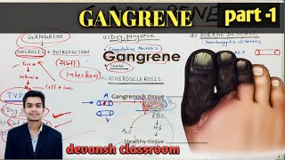 General Pathology lectures  GANGRENE  Hindi dry wet gas gangrene [upl. by Fiora]