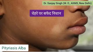 Pityriasis Alba चेहरे पर सफेद दाग Pityriasis PityriasisAlba vitiligo vitiligocure whitespots [upl. by Nadruoj]