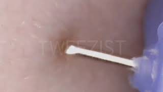 Remove ingrown hair with blackhead [upl. by Brighton]