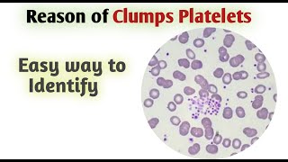 Platelets clumps under microscope [upl. by Carlotta]