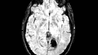 Cavernoma [upl. by Jauch]