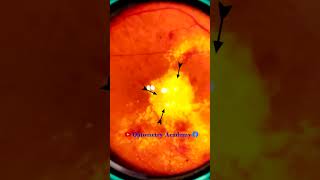 Diabetic retinopathy  Hemorrhages  Hard exudates  Fundus  Short Video 191 [upl. by Casper]