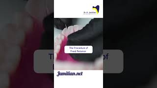 Procedure of Fixed Retainer dentist bracing fixedretainerRetainerOrthodonticsRetention [upl. by Ledniahs429]