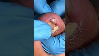 ingrown Teonail and Foot nail Removal  Dead skin removal Ep16  Master​Liu Beauty [upl. by Manaker]