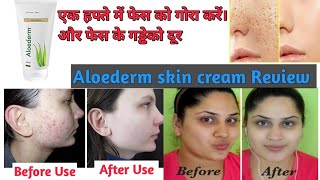 Aloederm skin cream Review and benefits in hindi  hindi health tips 4u [upl. by Dnalrah]