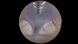 Endoscopic Third Ventriculostomy ETV [upl. by Randee207]