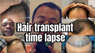 Hair transplant time lapse day 1 to day 140  Hair transplant day 1 to day 140 [upl. by Ingalls922]