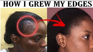 HOW TO GROW EDGES BACK THE NATURAL WAYHOME REMEDYHAIR JOURNEY [upl. by Nairad]