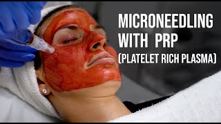 Microneedling with PRP Platelet Rich Plasma Renee Tucker Aesthetician  West End Plastic Surgery [upl. by Bruns14]