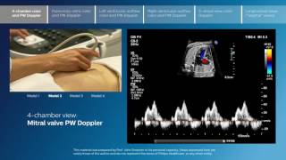 Advanced screening views of the fetal heart  Part 1  4chamber color and PW Doppler [upl. by Dragoon129]