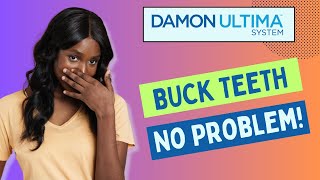 Buck Teeth No Problem with Damon Ultima Braces [upl. by Aiasi]