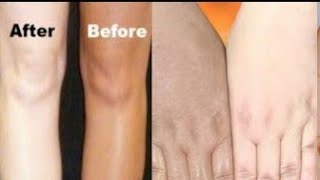 Sun Tan removed at home  How to get clear skin skin care  Ummi life shorts skincare [upl. by Oicangi]