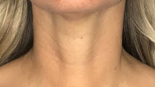 Scarless Thyroidectomy  Transoral Endoscopic Thyroidectomy Vestibular Approach [upl. by Keldon]