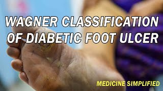 Wagner Classification of Diabetic Foot Ulcers  Diabetic Foot Ulcers Types [upl. by Emma974]