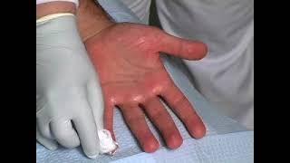 Botox for PALMAR Hyperhidrosis sweatypalms Dr David Pariser International Hyperhidrosis Society© [upl. by Ayokal28]