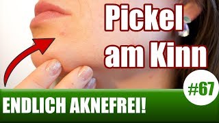 Pickel am Kinn loswerdenHormonelle Hautprobleme  FacemappingGesichtskarte ENDLICH AKNEFREI 67 [upl. by Lotsirhc]