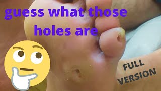 Plantar calluses How to remove them Medical pedicure [upl. by Ilenay308]