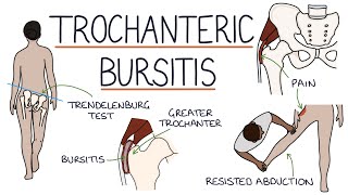 Understanding Trochanteric Bursitis [upl. by Ettenyar811]