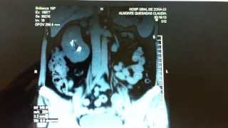 NEFROLITIASIS BILATERAL [upl. by Dex]