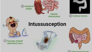 Intussusception with Homoeopathic management [upl. by Duester]