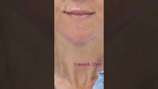 Neck lift Before amp After [upl. by Arratal]