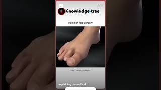 Toe surgery [upl. by Singhal]