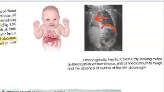 Pediatrics Diaphragmatic Hernia Congenial CDH Surgery [upl. by Dagmar]