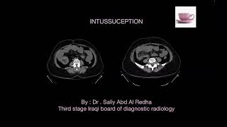 Intussusception [upl. by Nnylaj315]