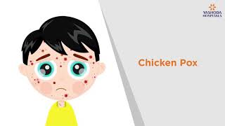 Chicken Pox Symptoms Causes Prevention and Treatment  Yashoda Hospitals [upl. by Hedve782]