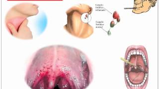 Streptococcus Pyogenes [upl. by Caryn589]