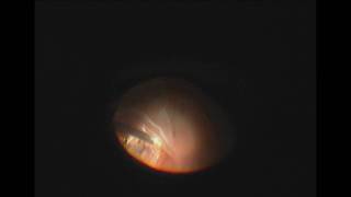 Vitrectomy and Perfluoron for Retinal Detachment with Giant Retinal Tear [upl. by Theadora492]