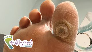 DEEP SATISFYING CALLUS TREATMENT [upl. by Nosiram]