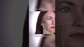 HIFU NonInvasive AntiAging Treatment for Wrinkles  The Aesthetics Clinic [upl. by Vivle]