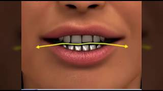 Curve of Spee  Dr Sarabjeet Singh  Chandigarh Orthodontics [upl. by Eiruam]