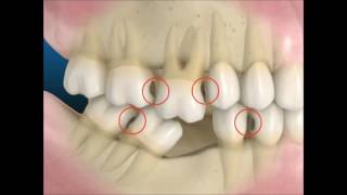 A perda de 1 dente e suas consequências [upl. by Zendah]