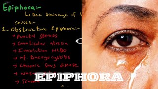 What is EpiphoraWatery Eye   Causes  examination  treatment [upl. by Kroll]