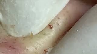 Big Cystic Acne Extraction Blackheads Milia Whiteheads Removal Pimple Popping Compilation 10009 [upl. by Renba]