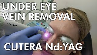 Under Eye Vein Removal Cutera NdYAG Laser  Dr Paul Ruff  West End Plastic Surgery [upl. by Salguod308]