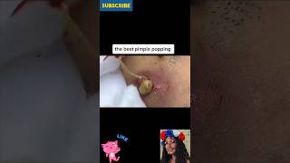 💙 The Best Pimple Popping From Face  Cyst Removal  Blackheads Removal shorts asmr [upl. by Surdna301]