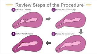 Hysteroscopic Repair of Cesarean Scar Isthmocele [upl. by Hasty]