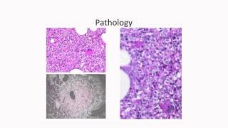 Molecular Profiling of Myelodysplastic Syndromes [upl. by Joleen]